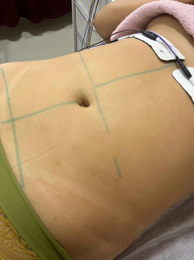 Antes - Protocolo Personalizado