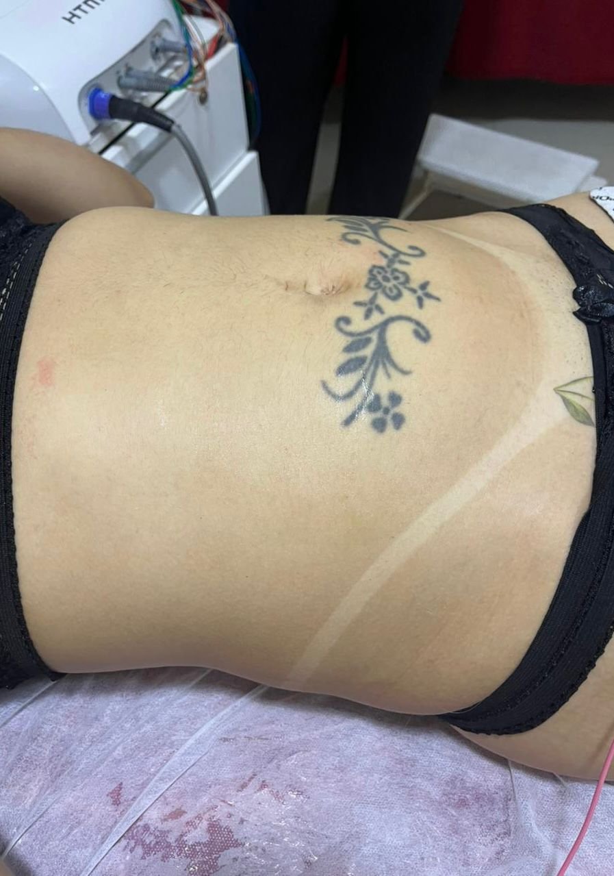 Antes - Protocolo Personalizado